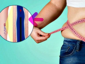 Estudo BEAT Obesity publica resultados de 6 meses com perda de peso sustentada em embolização bariátrica